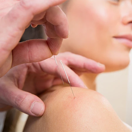 Woman Receiving Acupuncture